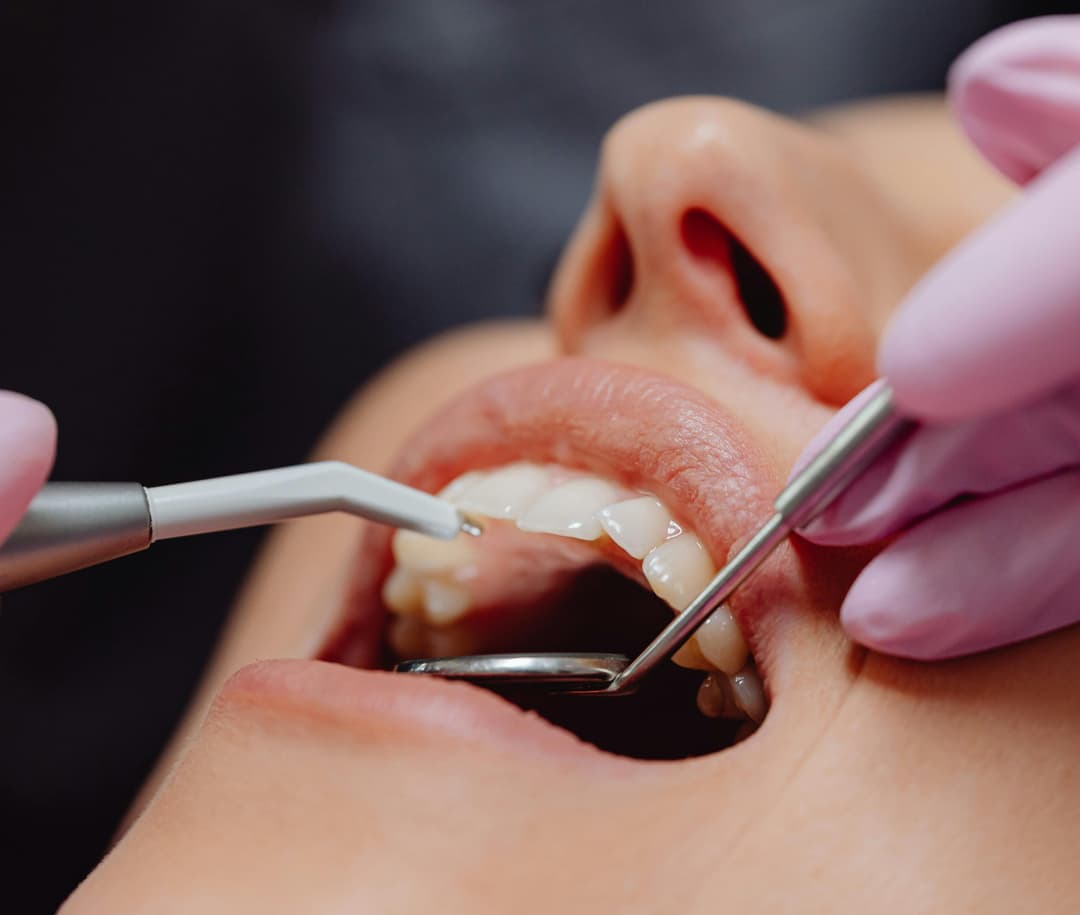 Dantų plombavimo procedūra